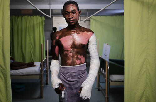 Treating Burn and Trauma Victims in Haiti Treating Burn and Trauma Victims in Haiti